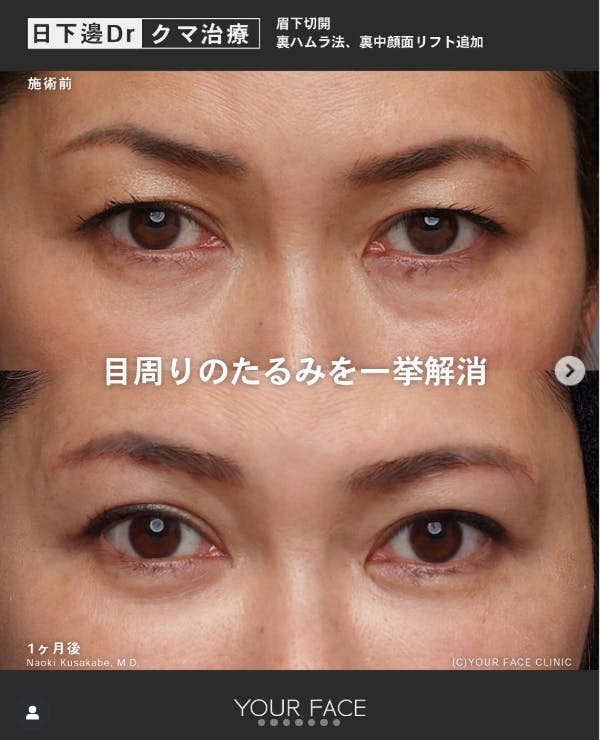 【女性・目元】眉下切開 裏ハムラ法 中顔面リフト_before_aftar